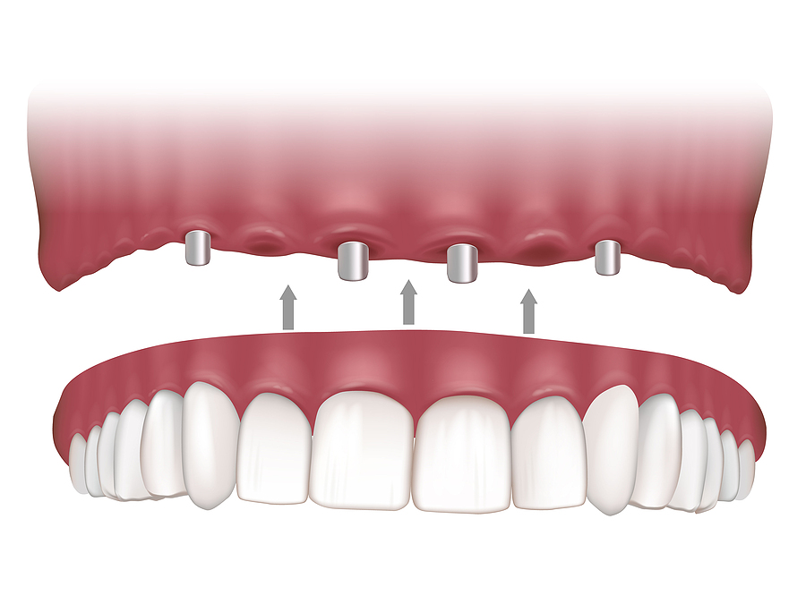 Transform Your Smile with All-On-Four Implants in San Jose, CA