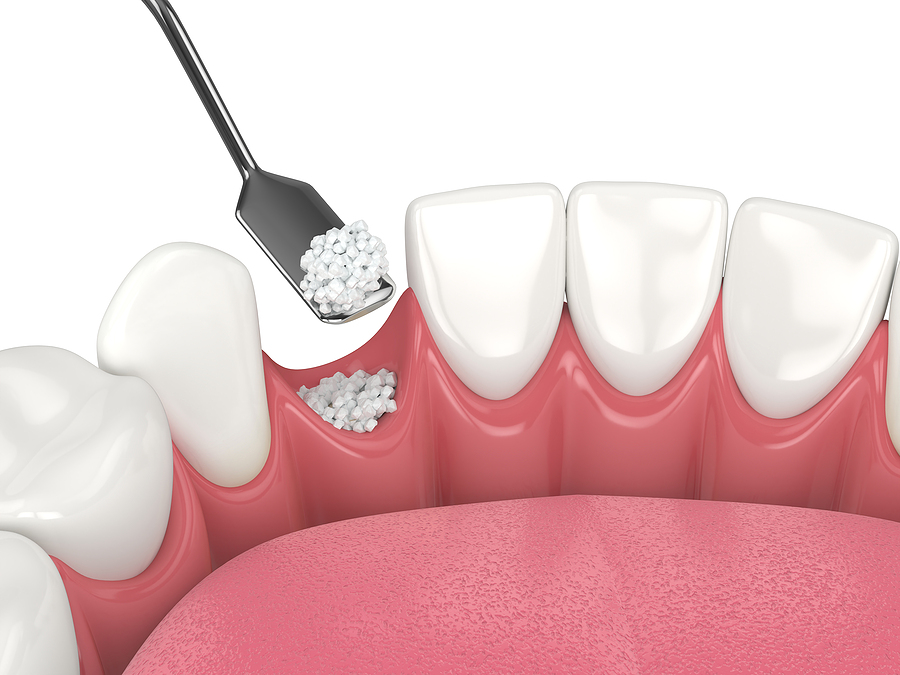 Bone and Soft Tissue Grafting in San Jose, CA: Key Procedures for Lasting Dental Health