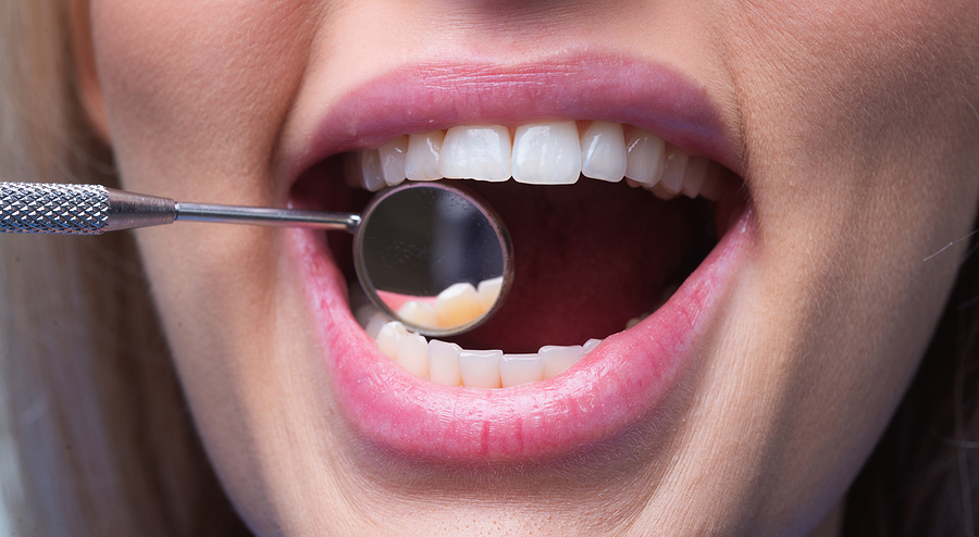 Do I Need a Bone Graft Before Getting Dental Implants?